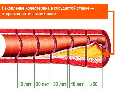 Атеросклероз