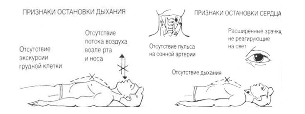 Остановка сердца, дихания